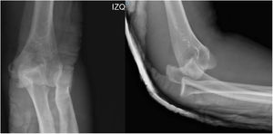 Radiografía AP y lateral de codo izquierdo, inmovilización con férula posterior. Se evidencia re-luxación postero-lateral del codo dentro de la inmovilización.