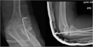 Radiografía AP y lateral de codo izquierdo, inmovilización con férula posterior y clavo transcapitelar. Se observa reluxación del codo.