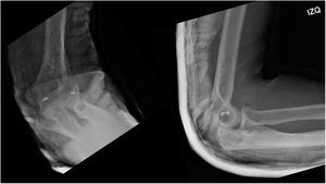 Radiografía AP y lateral de codo izquierdo, inmovilización con férula posterior. Postoperatorio de reconstrucción ligamentaria colateral medial y lateral, adecuada relación y congruencia articular.