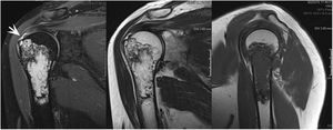 En la RM hay ruptura total del tendón supraespinoso en la huella (flecha) y tendinosis del infraespinoso.