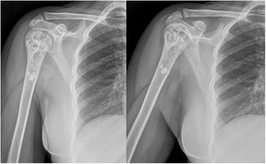 Las imágenes radiográficas al año de control no muestran cambios en el encondroma respecto a las radiografías preoperatorias.