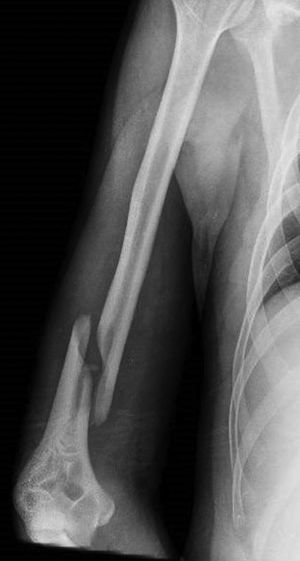 Fractura inicial humero distal.