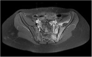 Corte axial de imagen por resonancia magnética secuencia T1- TSE de artritis sacroilíaca, osteomielitis en hemisacro y hueso ilíaco izquierdo.