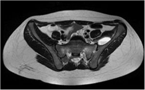 Corte axial de imagen por resonancia magnética secuencia T2 de artritis sacroilíaca, osteomielitis en hemisacro y hueso ilíaco izquierdo.