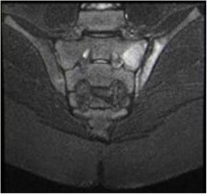 Corte coronal de imagen por resonancia magnética secuencia T2 de edema óseo en sacroilíaca izquierda.