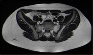 Corte axial de imagen por resonancia magnética secuencia T2 de edema óseo en sacroilíaca izquierda.