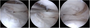 Se realiza artroscopia inicial, limpieza de fibrosis en compartimento externo, regularización de muro meniscal, encontrando lesión condral importante grado II-III en escala de Outerbridge en fémur y tibia. (Tomado de autores).