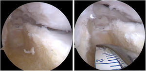Posterior, se talla canal óseo en meseta tibial, paralelo a espinas tibiales, de 8mm cm de profundidad y 1cm de ancho en profundidad y 1cm en parte superficial, logrando un túnel con forma de trapezoide, para no lesionar cartílago de crecimiento, sin perforar cortical posterior y lograr un cerrojo para el momento de colocar el bloque óseo del injerto cadavérico. (Tomado de autores.).