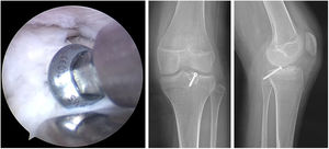 Se coloca bloque óseo en túnel confeccionado a presión. Por seguridad, se realizó fijación con tornillo canulado de 4.0mm evitando transgredir la fisis de crecimiento, control con radiografías anteroposterior y lateral de rodilla. (Tomado de autores).