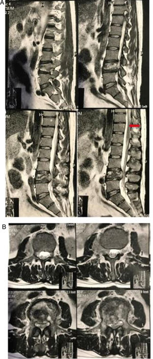 A y B. RMN dos meses antes de consulta inicial del paciente con compromiso vertebral de L4 con compresión radicular. Nótese ligeros cambios que sugieren infiltración a nivel de T12 (flecha).