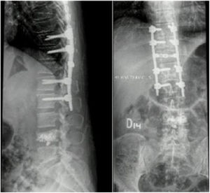 Radiografías postquirúrgicas, con instrumentación en T10-L1 y vertebrolastia en L4.