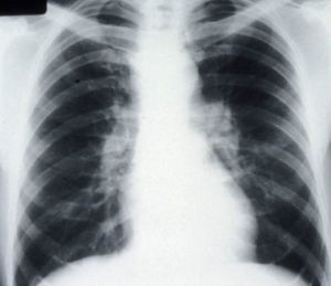 Radiografía de tórax con adenopatía hiliar bilateral.