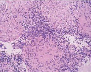Hematoxilina-eosina, biopsia ganglionar con granulomas bien formados no necrosantes.