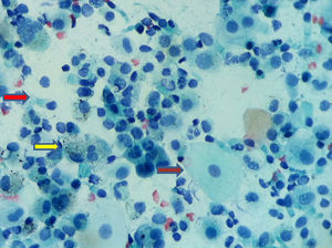 Extendido con cytospin. El volumen y detalle celular es notable, junto con poca representación de hematíes en este campo. Papanicolaou 40x. flecha roja: célula respiratoria; flecha amarilla: macrófago; flecha marrón: célula escamosa.