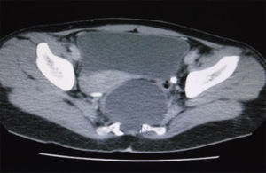 Imagen de resonancia magnética, corte axial, en la cual se observa defecto óseo sacro anterior de donde sale el saco herniario.