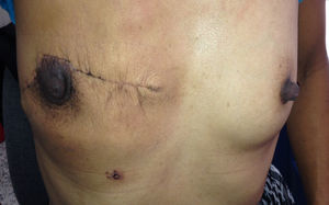 Aspecto posquirúrgico de la paciente, un mes después de la cirugía de resección del tumor.