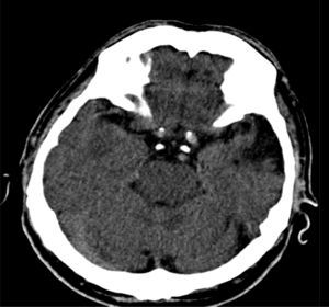 TAC cerebral simple, que muestra área de encefalomalacia temporal izquierda.