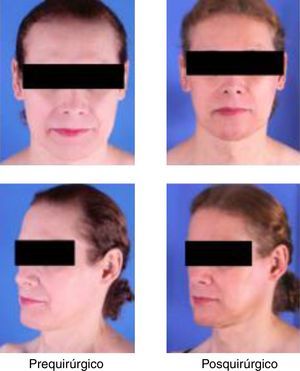 Cambios pre y posquirúrgicos de la cirugía de feminización; imágenes tomadas por el servicio de cirugía plástica del Hospital de San José.