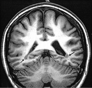 Heterotopia periventricular occipital. T 1: imagen coronal demostrando heterotopia periventricular bioccipital (flechas). Fuente: tomado de Taylor et al.9.