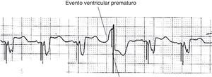La respuesta sentido ventricular. Ejemplo de la función de respuesta de detección ventricular. Estos aparecen con frecuencia como artefactos de estímulo tardíos dentro de ectopias ventriculares y representan el intento de dispositivos de «resincronizar» el evento ventricular. Modificada de Lloyd et al.22.