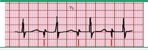 Marcapasos auricular. Registro electrocardiográfico, en derivación V5 donde se observa una única espiga (marcado por las líneas inferiores) seguido a una onda P, con intervalo PR normal y complejo QRS normal. Fuente: Prutkin et al.20.