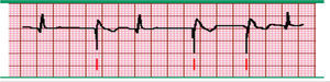 Marcapasos ventricular. Registro electrocardiográfico donde se observa una única espiga de estimulación (marcado por las líneas inferiores) seguido por un complejo QRS ancho y atípico que asemeja a un latido ventricular. Se presentan algunos complejos QRS normales que suprimen la función del marcapasos cuando aparecen más rápido que la tasa configurada. Fuente: Prutkin et al.20.