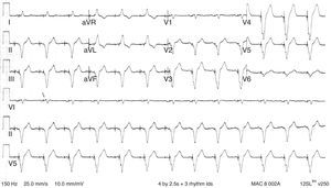 Electrocardiograma normal de estimulación ventricular. El trazado muestra los complejos QRS ensanchados típicos de ritmo ventricular. Se observa la similitud con un patrón de bloqueo de rama izquierda con eje izquierdo, así como discordancia en la onda T/QRS. Modificada de Cardall et al.21.