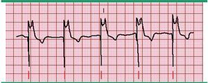 Marcapasos ventricular con estimulación del 100%. Registro electrocardiográfico donde se observa cada complejo QRS precedido por un estímulo (marcado por las líneas inferiores). El complejo QRS es anormal, ancho, atípico, asemeja un latido ventricular. Los complejos QRS usualmente presentan una configuración de bloqueo de rama izquierda ya que es más común que el electrodo ventricular se encuentre en el ventrículo derecho. Fuente: Prutkin et al.20.