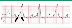 Electrocardiograma con estimulación biventricular. Modificada de Prutkin et al.20.