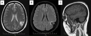 Resonancia cerebral simple y contrastada. A) Secuencia T2 en corte axial. B) Secuencia FLAIR en corte axial. C) Secuencia T1 en corte sagital.