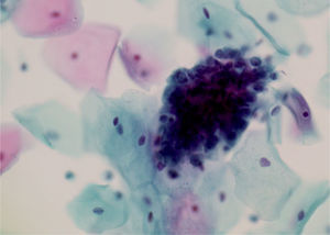 Células endocervicales con agrupamiento e hipercromasia.