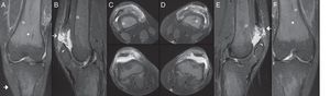 Resonancia magnética de rodillas en secuencia STIR, en planos coronal (A y F), sagital (B y E) y axial (C y D), con edema de tejidos blandos, rotura de los TC (flechas) (B y E), con retracción de los cabos, edema óseo trabecular en la entesis en la rótula (cabeza de flecha) y aumento de intensidad de señal de las corticales óseas (flecha hueca). Además, se observa recambio óseo medular por componente de médula roja.