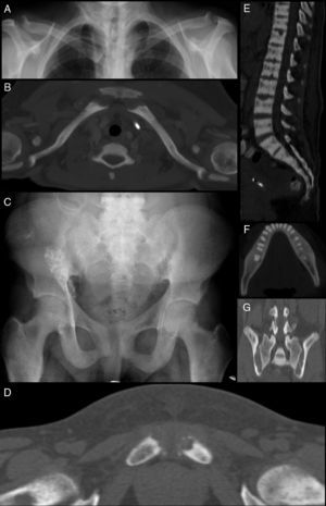 Manifestaciones radiográficas y tomografías de hiperparatiroidismo. Se ve esclerosis subcondral en articulaciones acromioclavicular, esternoclavicular (A y B), sacroilíaca y de la sínfisis púbica (C, D y G), además de esclerosis ósea vertebral (E) y del maxilar inferior perialveolar (F).