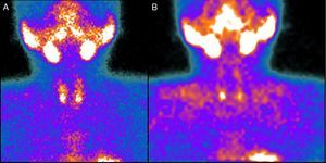 Gammagrafía paratiroidea con tetrofosmin99mTc-370MBq: imágenes panorámicas evidenciando intensa captación del radiofármaco hacia los polos inferiores de la tiroides correspondiente con 2 glándulas paratiroides inferiores (A). A los 120min se observa persistencia de la captación anómala del radiofármaco en las glándulas paratiroides inferiores (B).