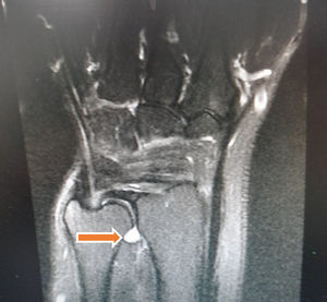 Resonancia magnética fase T2, con supresión de grasa. Corte coronal que muestra quiste intraarticular de la articulación radiocubital distal.