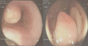 Masa en el tercio inferior de esófago, gastropatía antral y úlcera duodenal Forrest III.
