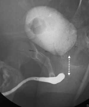 Uretrografía anterógrada y retrograda en paciente con lesión traumática de uretra posterior. No hay plenificación con material de contraste de cuello vesical ni de uretra posterior. La línea punteada señala la amplia separación entre ambos segmentos uretrales.