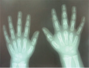 Lesiones quísticas que comprometen falanges medias y proximales en manos bilaterales presentes en un niño de 8 años con sarcoidosis de inicio temprano (caso 1). El reporte histológico fue compatible con enfermedad de Ollier, la biopsia de piel confirmó sarcoidosis.