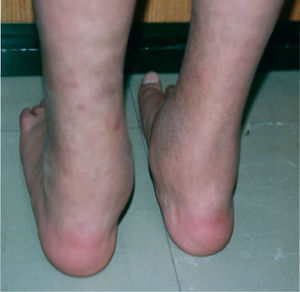 Paciente con sarcoidosis de inicio temprano y sinovitis tipo “cauchosa” característicamente indolora ubicada en tobillos (caso 5).