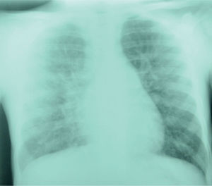 Paciente con sarcoidosis de inicio temprano y compromiso pulmonar intersticial asociado a adenomegalias hiliares. Inicialmente, recibió tratamiento como tuberculosis cutánea; posteriormente, se confirmó el diagnóstico de sarcoidosis (caso 5).
