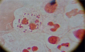 Diplococos Gram negativos intracelulares en muestra del líquido articular.