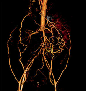 Vista frontal angiotac obstrucción de arterias colaterales.