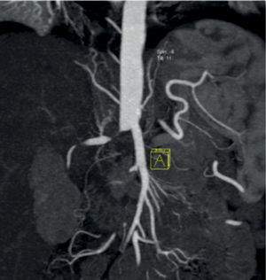 Vista tomográfica de trombosis de aorta abdominal.
