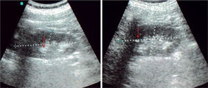 Ultrasonido renal, en la que se muestran imágenes hiperecogénicas sugestivas de calcificaciones renales, ambos riñones con dimensiones normales, riñón derecho de 10.1 4.6cm y riñón izquierdo con 10.5 4.7cm.