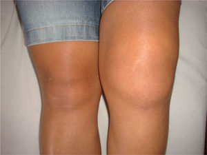 Paciente con aumento de volumen de la rodilla izquierda