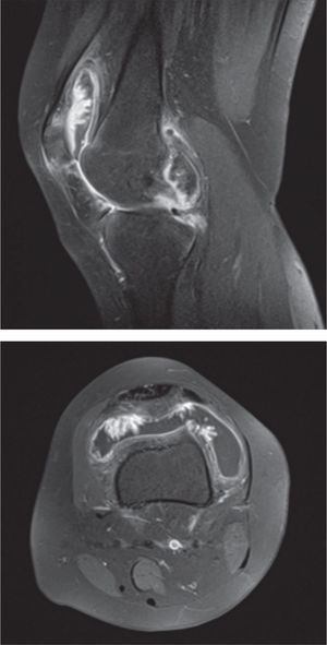 RMN que muestra hipertrofia sinovial y una masa de partes blandas intra-articular, con hipointensidad en las secuencias T1 corte transversal y en la secuencia T2 corte sagital