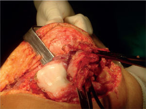 Cirugía terapéutica con exéresis sinovial