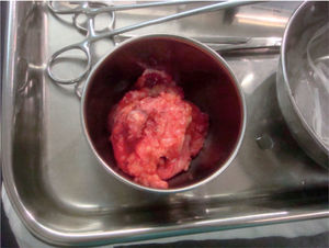 Masa Intra-articular extraída de la rodilla izquierda