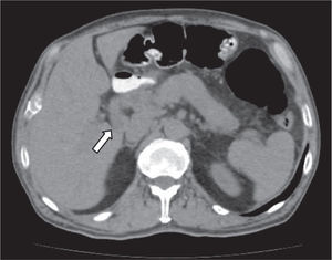 Abdominal computed tomography scan with contrast. Notice mass in the head of the pancreas (arrow)