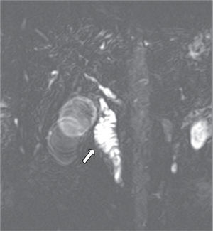 Cholangio-magnetic resonance imaging showing dilation of the pancreatic duct (arrow)